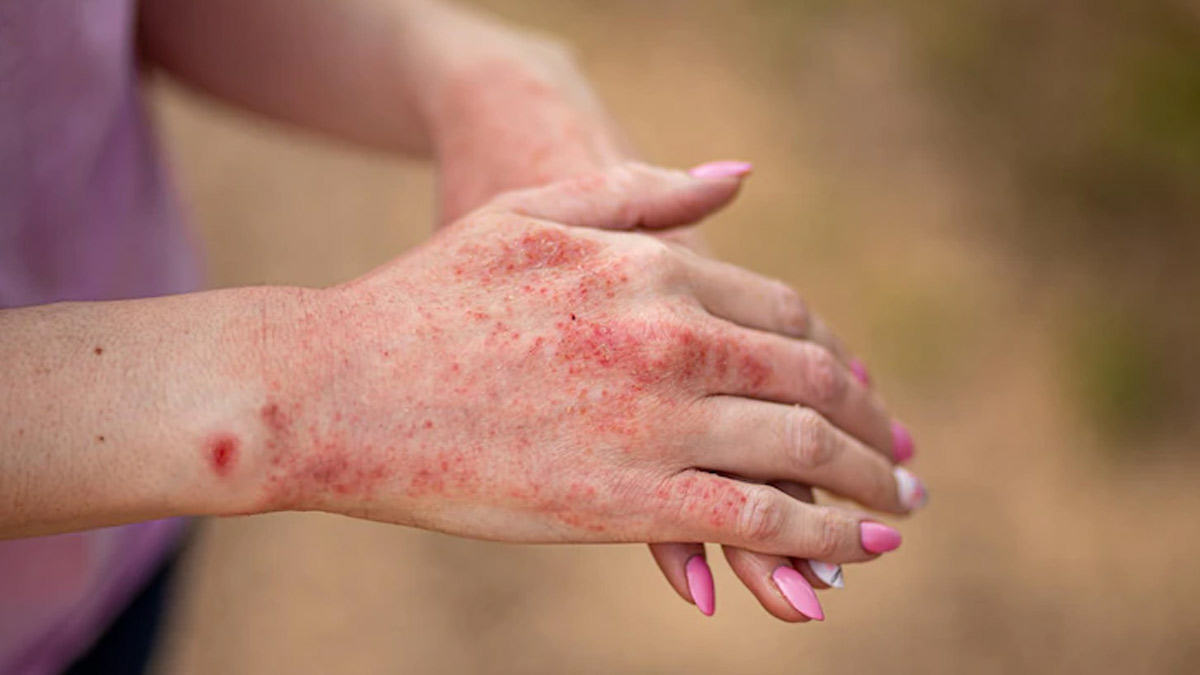 Skin and Stress: Connection Between Stress and Skin Reactions